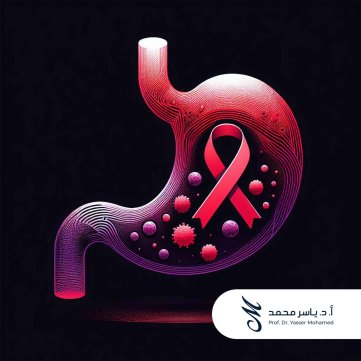 Prof. Dr. Yasser Mohamed - Stomac Cancer Poster