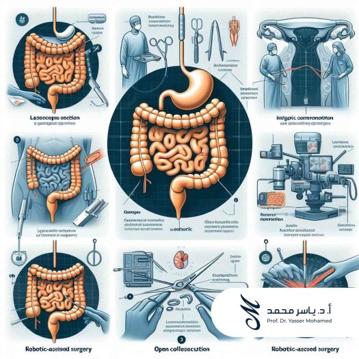 Prof. Dr. Yasser Mohamed - What are the Types of Colon Cancer Surgeries